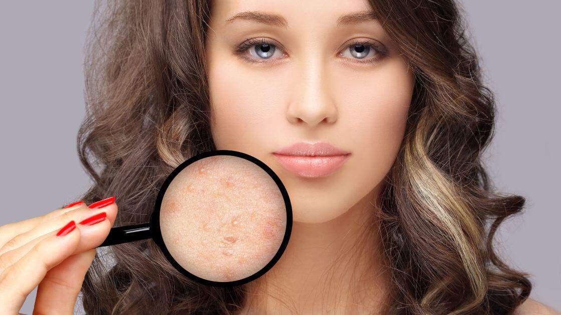how to get rid of acne scars on face