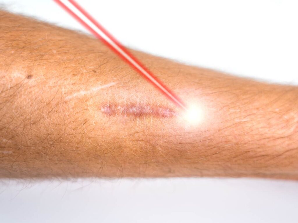 Laser Skin Resurfacing For Scars