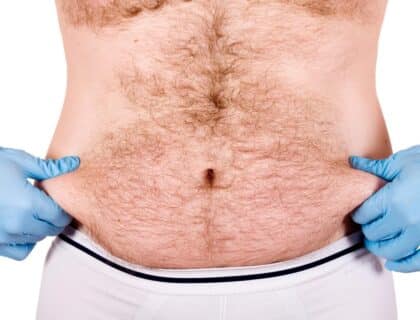 Liposuction for Men