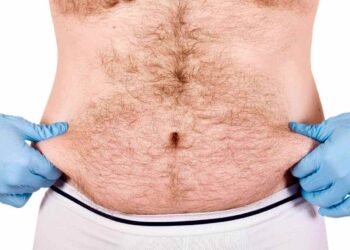 Liposuction for Men