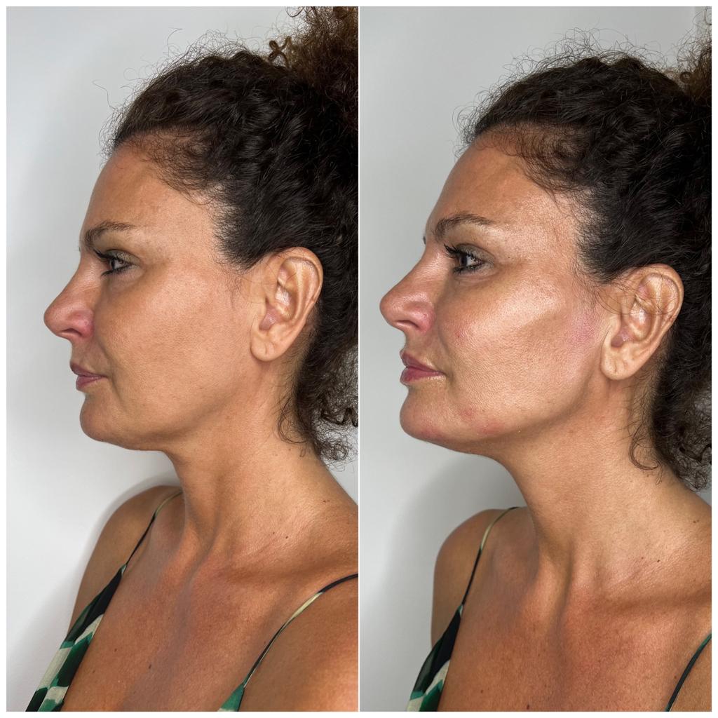 Cheek Dermal Fillers Before and After