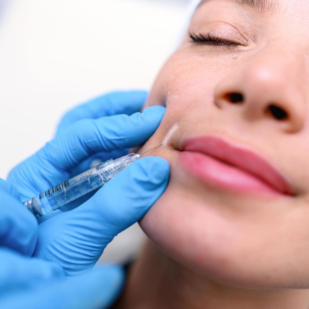 Cheek Dermal Fillers Procedure 