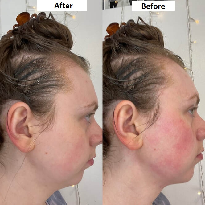 Gua Sha Before and After Transformation 