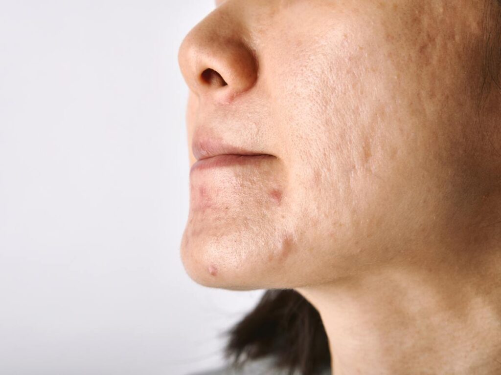 Remove Acne Scars on Face