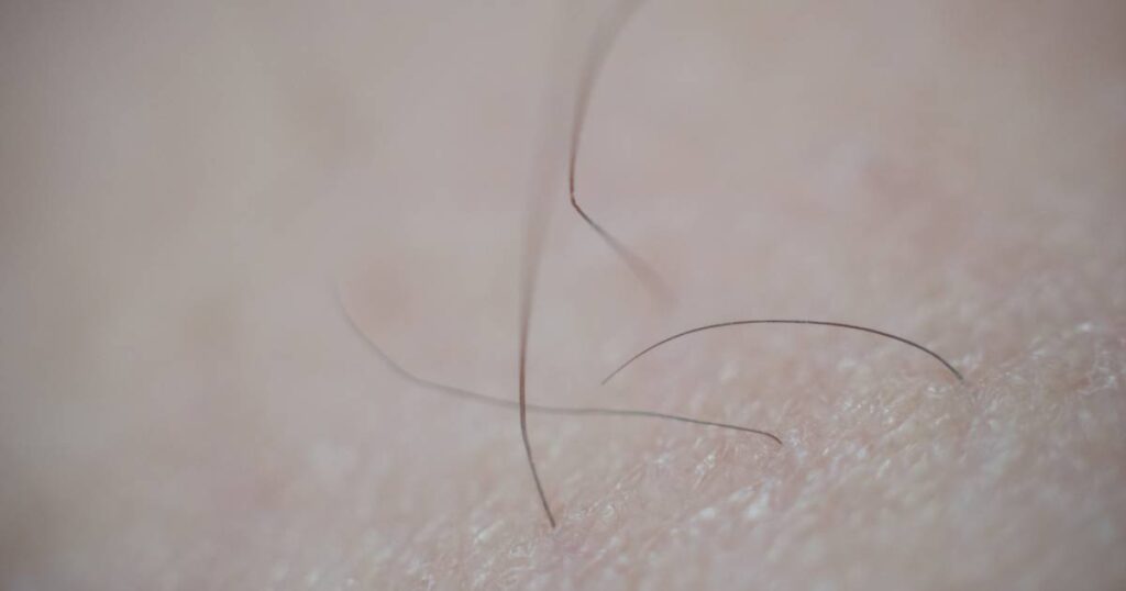 How to remove pubic hair permanently at home naturally