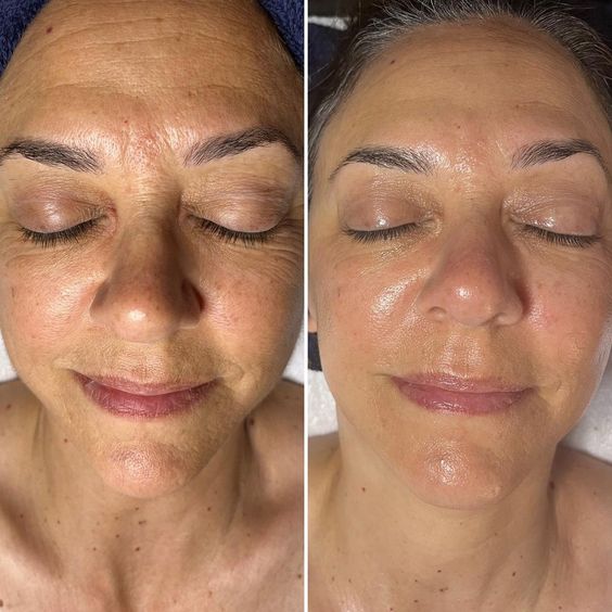 Mesotherapy Before and After