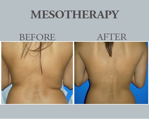 Benefits of Mesotherapy For Weight Loss