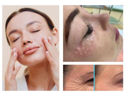 NCTF Injections For Anti Aging