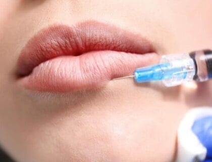 1 2 Syringe Lip Filler Before and After