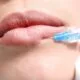1 2 Syringe Lip Filler Before and After