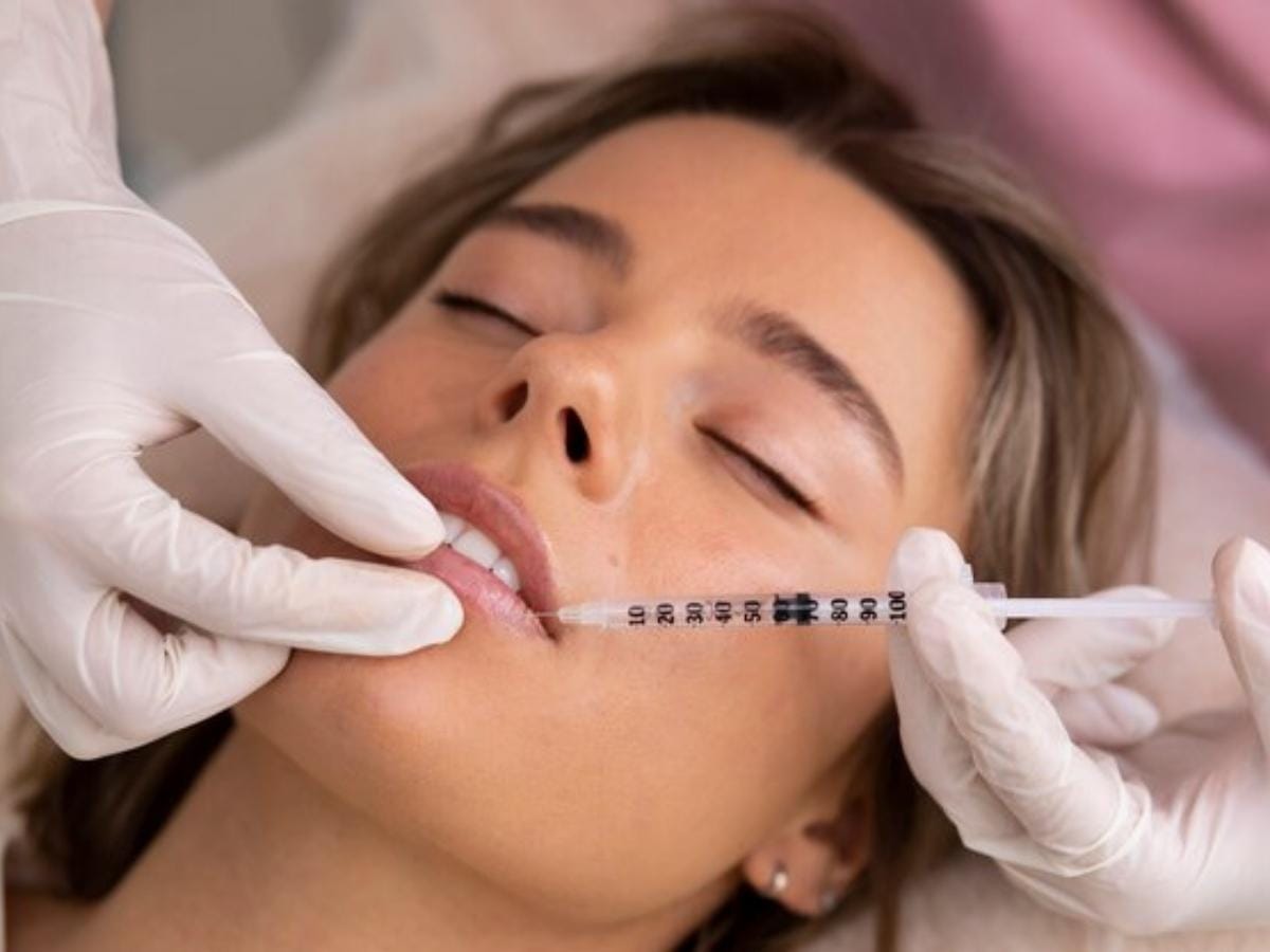 1 ml Lip Filler
