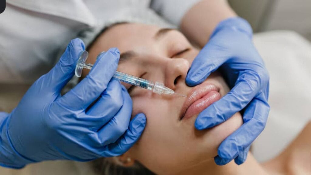 1 Syringe Lip Filler Before and After